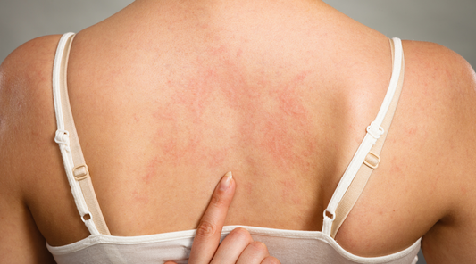 Top 7 Soaps for Eczema Relief: Say Goodbye to Itchy Skin!